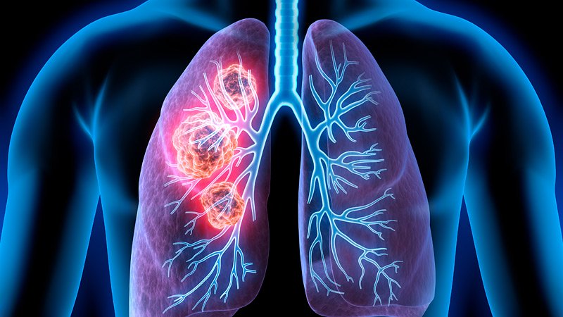 lung cancer treatment 